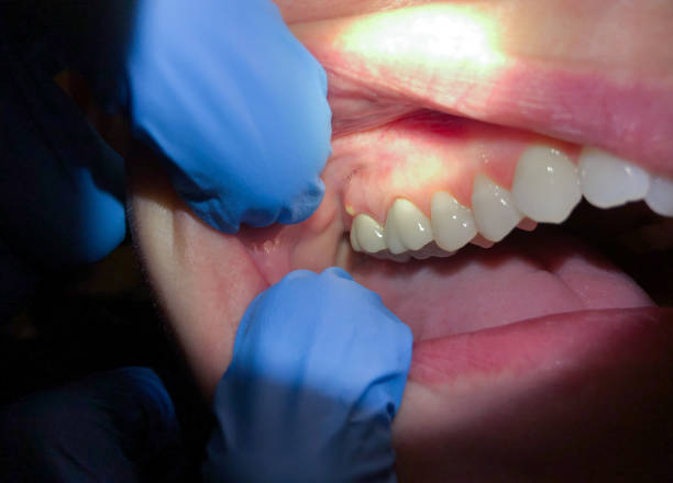 Best Emergency Dental Extractions in Shepherdstown, WV